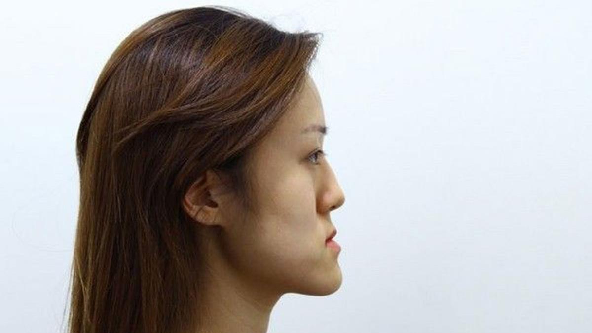 TƯỚNG MẶT LƯỠI CÀY Ở PHỤ NỮ THỂ HIỆN QUA TỶ LỆ MẶT KHÔNG CÂN ĐỐI NHÌN TỪ BÊN CẠNH