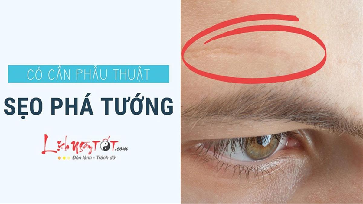 VẾT SẸO Ở CẰM ẢNH HƯỞNG ĐẾN ĐƯỜNG TÀI LỘC VÀ SỰ NGHIỆP THEO QUAN NIỆM XƯA